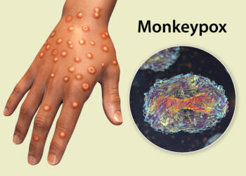 Africa CDC Declares Mpox a Public Health Emergency Amid Rapid Spread