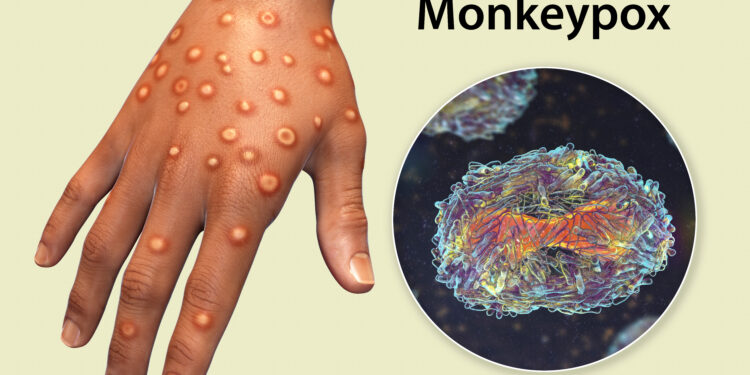 Africa CDC Declares Mpox a Public Health Emergency Amid Rapid Spread